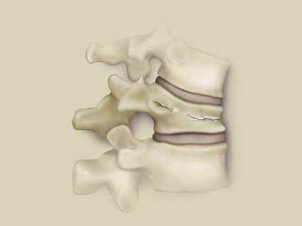 Клинична картина при фрактури в гръбначния стълб