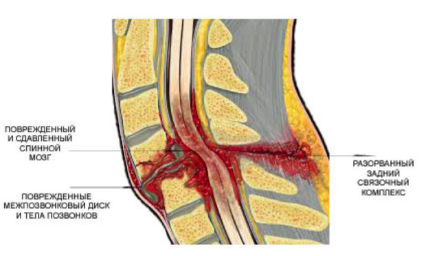 Клинична картина при фрактури в гръбначния стълб