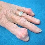 Индексният пръст на лявото или дясното рамо наранява: причините за болката в ставата
