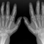 Индексният пръст на лявото или дясното рамо наранява: причините за болката в ставата