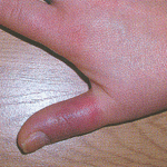 Сливът на пръста е възпален: лечение на възпаление