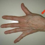 Съединението на палеца боли: причините за болка в дясната и лявата ръка