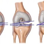 Коляното боли с натоварването: боди болка в колянната става