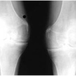 Коляното боли по време на флексия и удължаване: лечение на колянната става