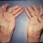Ръката на ръката боли, когато се огъва: какво да прави, причините за болка в дясната и лявата ръка