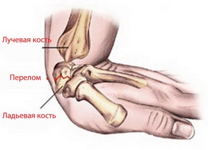 Лечение след фрактура на ръката
