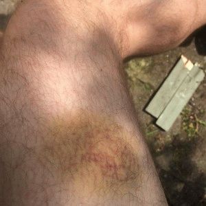 Лечение при удар на домашен крак