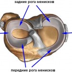 Лечение на кистата на менискуса на колянната става (ганглион и параменик)