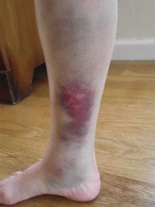 Лечение на хематома на крака след нараняване