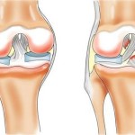 Лечение на менискуса на колената