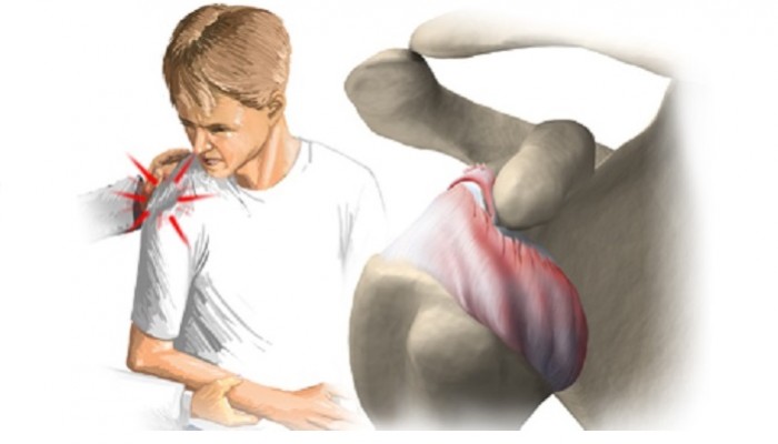 Лечение на руптура на сухожилията и сухожилията на раменната става
