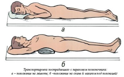 Варианти на лечение на фрактури на лумбалния гръбначен стълб