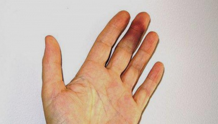 Какво да правим с нараняване на пръстите?