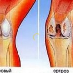 Защо коленете болят при жени след 50 години