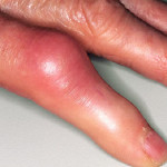 Защо пръстите са болки: причините за болката на ставите на пръстите на дясната и на лявата ръка