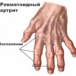 Защо се боят ставите на пръстите: какво да правите и как да лекувате причините за болката