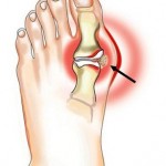 Защо палеца на крака боли при ходене и огъване: причините за болката
