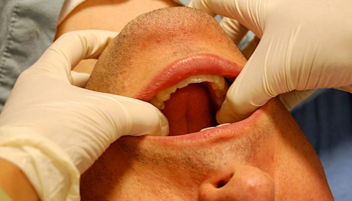 Дислокация и сублуксация на челюстта: симптоми и лечение