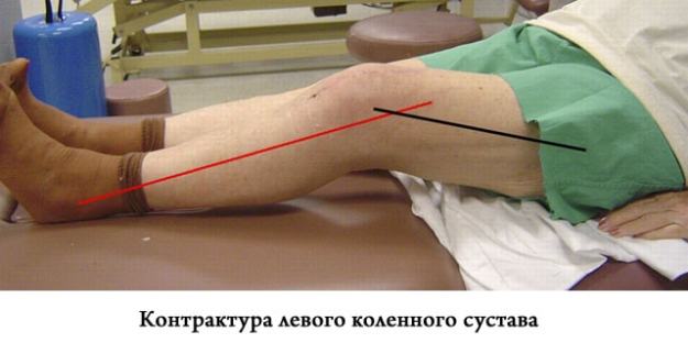 Развитие на колянната става след травма