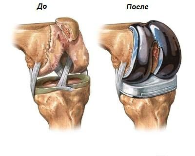 Как да се лекува болка в колянната става?