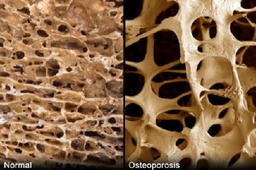 Какви методи за лечение на остеопорозата предлага литературата?