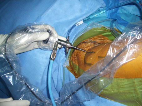 Артроскопия на колянната става като метод за лечение и диагностика