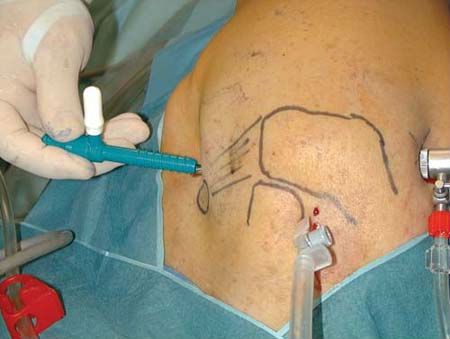 Артроскопия на колянната става като метод за лечение и диагностика