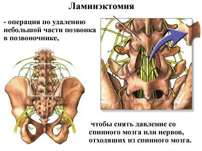 Основни видове операции на гръбначния стълб