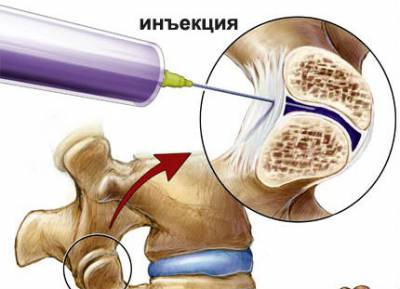 Блокада на гръбначния стълб като ефективен метод за елиминиране на болката