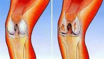 Комплексна терапия на колянната гонартроза