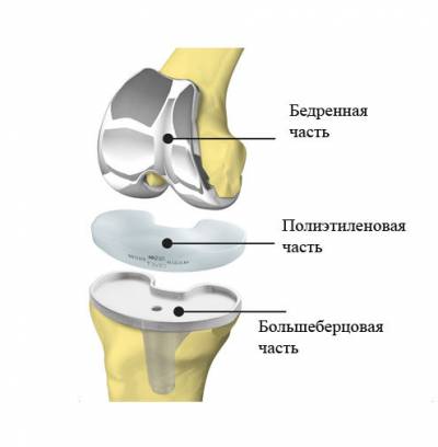 Експлоатация за подмяна на колянната става с ендопротеза