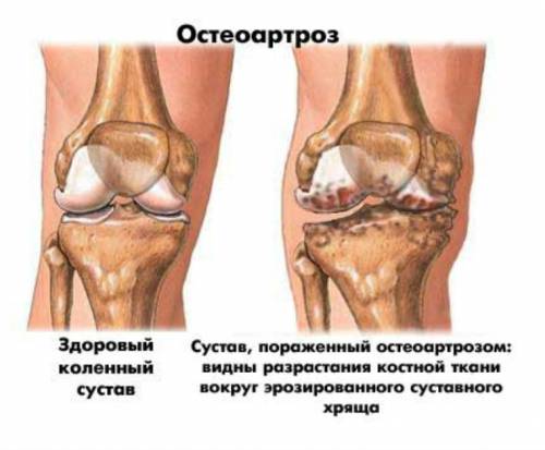 Експлоатация за подмяна на колянната става с ендопротеза