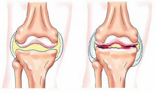 Какво и как да се лекува възпаление на колянната става