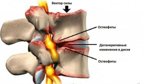 Ефективни методи на спондилоза на гръбначния ствол