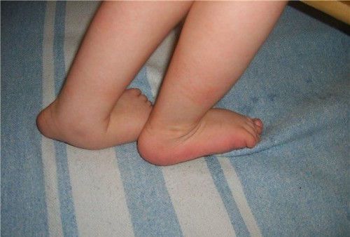 Как да се лекува плосък крак в детето