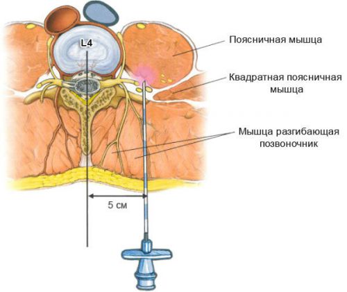 Инжекции с остеохондроза на лумбалния гръбначен стълб