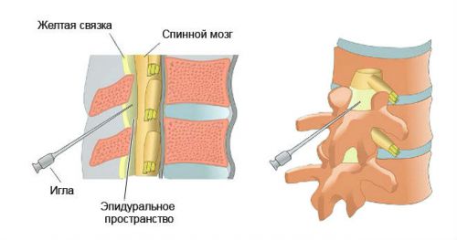 Инжекции с остеохондроза на лумбалния гръбначен стълб