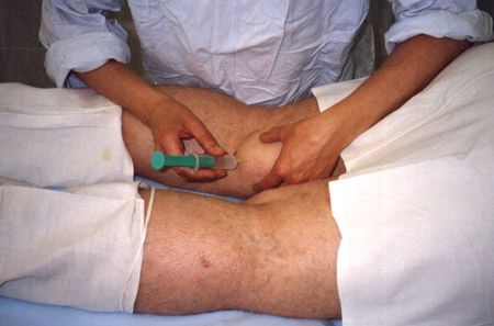Как да се лекува киста на коляното