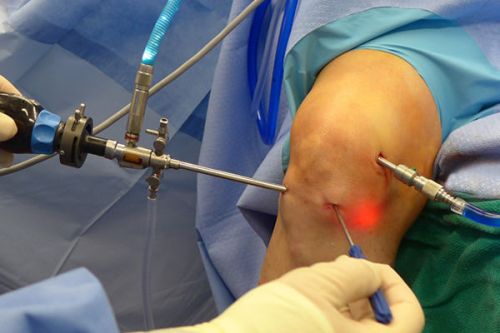 Лечение на менискуса на колянната става без хирургия