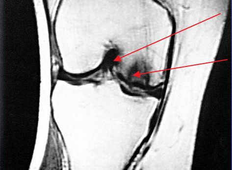 Какво представлява блокадата на колянната става