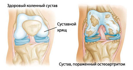 Как трябва да се лекува артрит на коляното?
