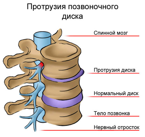 Как трябва да се лекува изпъкналостта на шийния гръбначен стълб?