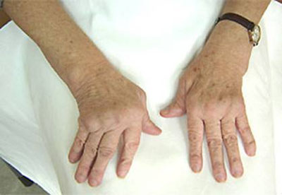 Как да се лекува артроза на пръстите: какво препоръчват лекарите?