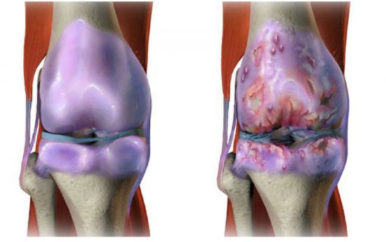 Как да се лекува артроза на коляното съвместно фолк средства