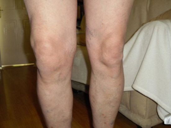 Как да се лекува артроза на коляното съвместно фолк средства