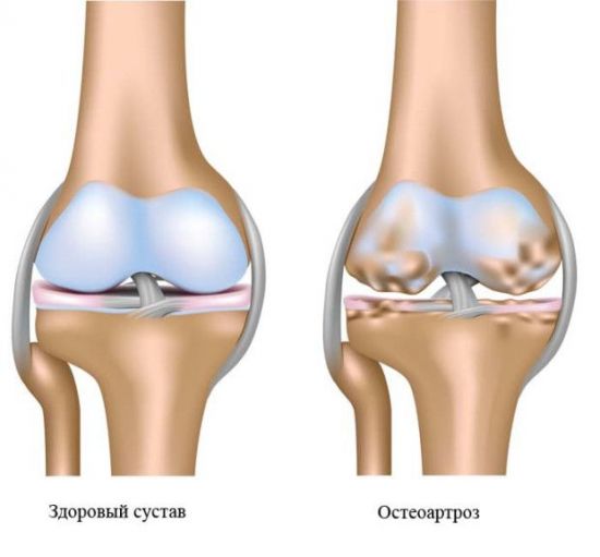 Как да се лекува артроза на коляното