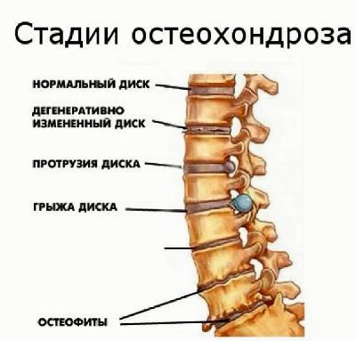Как да се лекува остеохондроза на гръбначния стълб