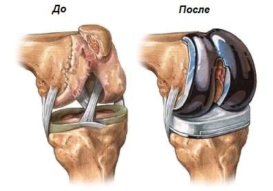 Подмяна на коляното (ендопротезиране)
