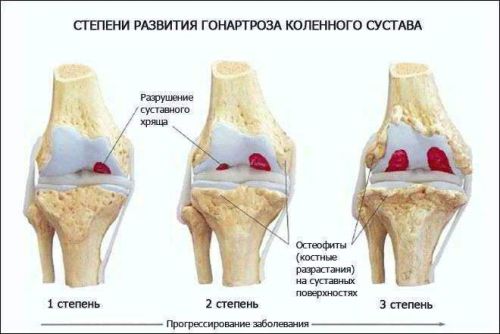 Таблетки с артроза на коляното