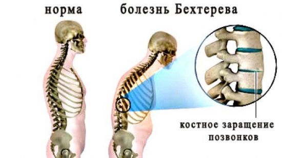 Тракционна терапия на гръбначния стълб